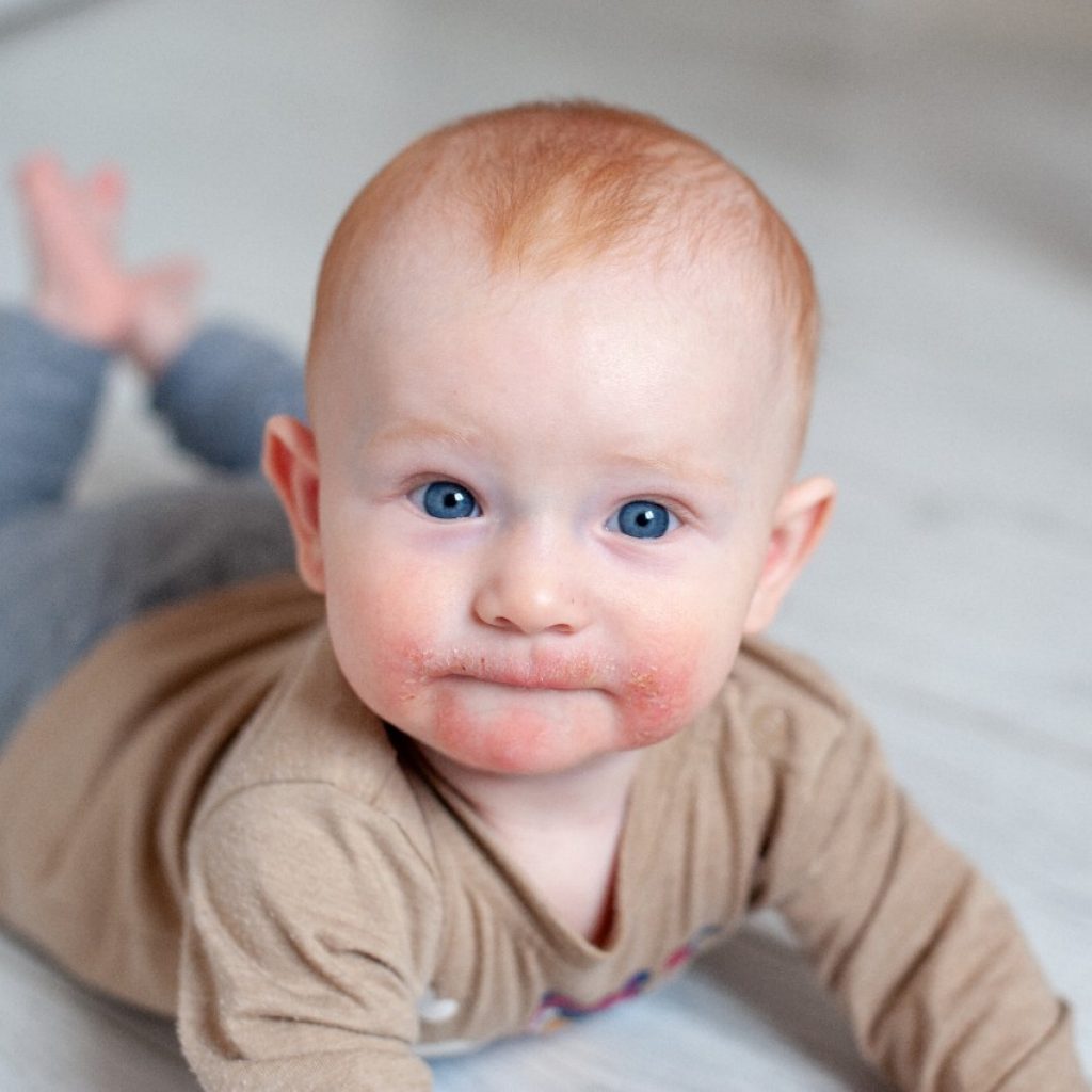 Neurodermatitis in babies signs and treatment Helsana