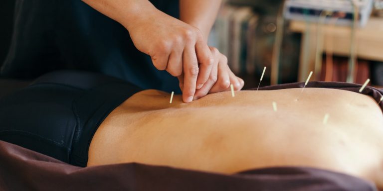 Back of a person lying down with inserted needles